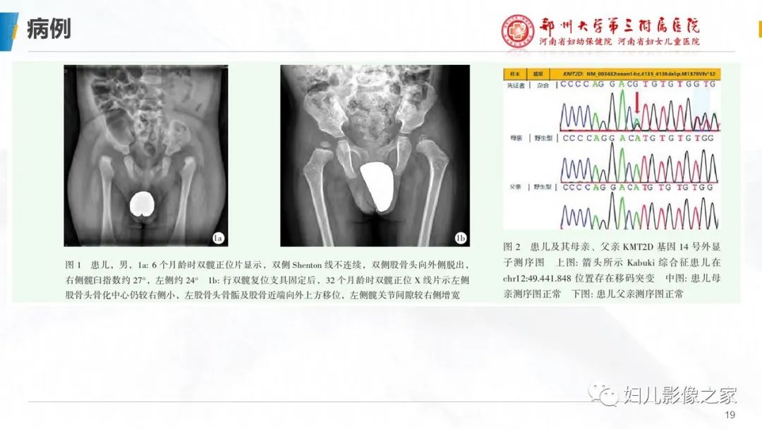 影像PPT - 【PPT】Kabuki综合征的影像诊断-19