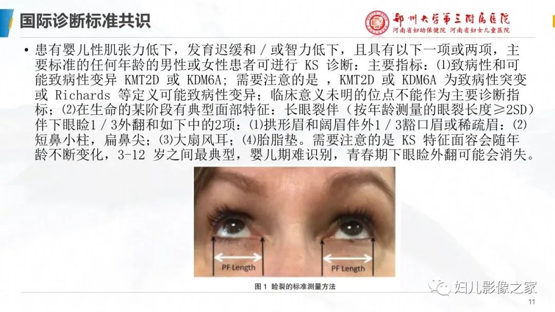 影像PPT - 【PPT】Kabuki综合征的影像诊断-11