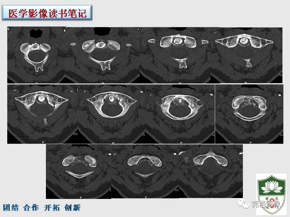 影像PPT - 【PPT】齿状突加冠综合征-3