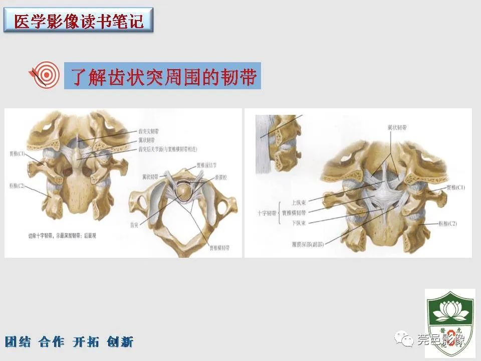 影像PPT - 【PPT】齿状突加冠综合征-8