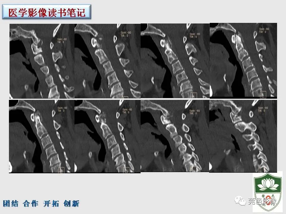 影像PPT - 【PPT】齿状突加冠综合征-4