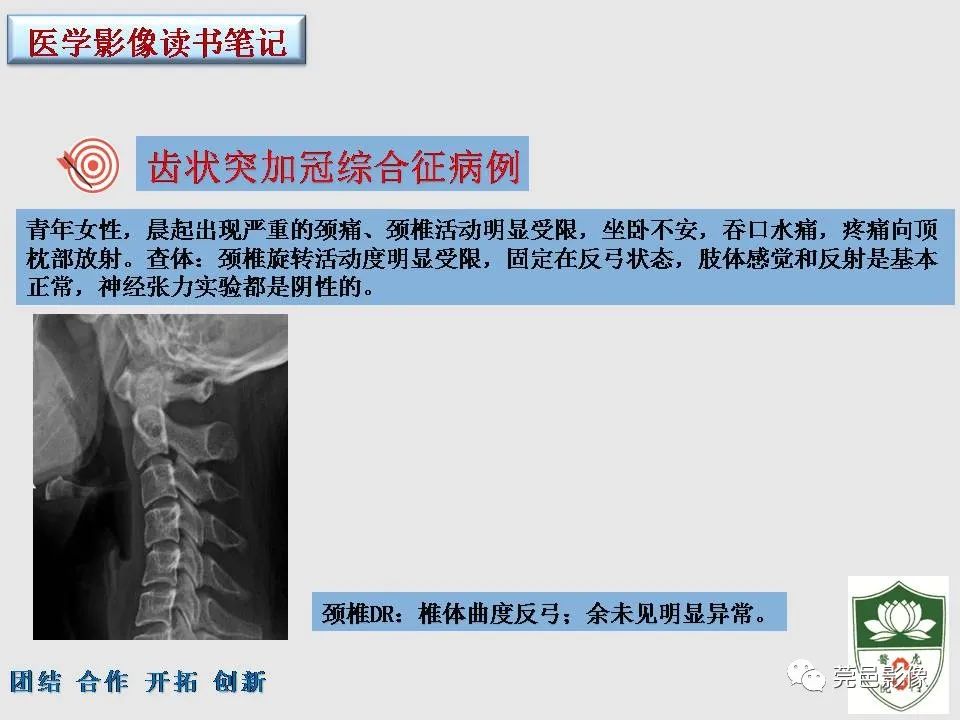 影像PPT - 【PPT】齿状突加冠综合征-12