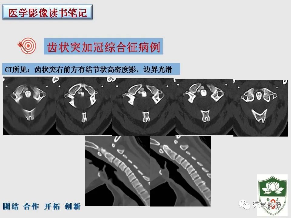 影像PPT - 【PPT】齿状突加冠综合征-13