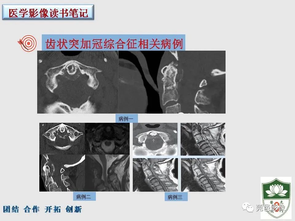 影像PPT - 【PPT】齿状突加冠综合征-14
