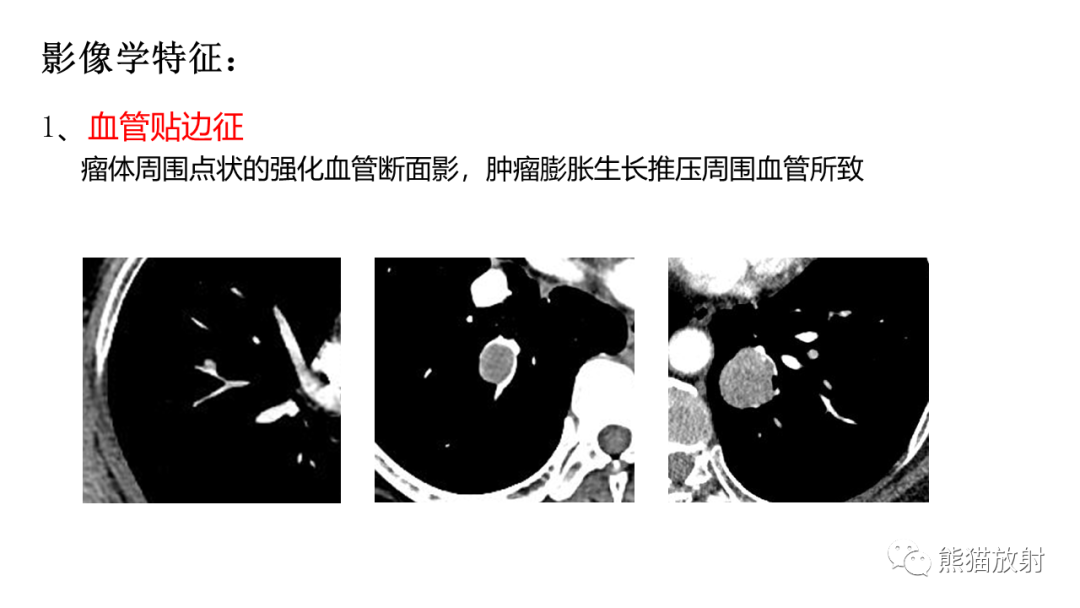 影像PPT - 【病例】肺孤立性纤维瘤 VS 硬化性肺细胞瘤-28