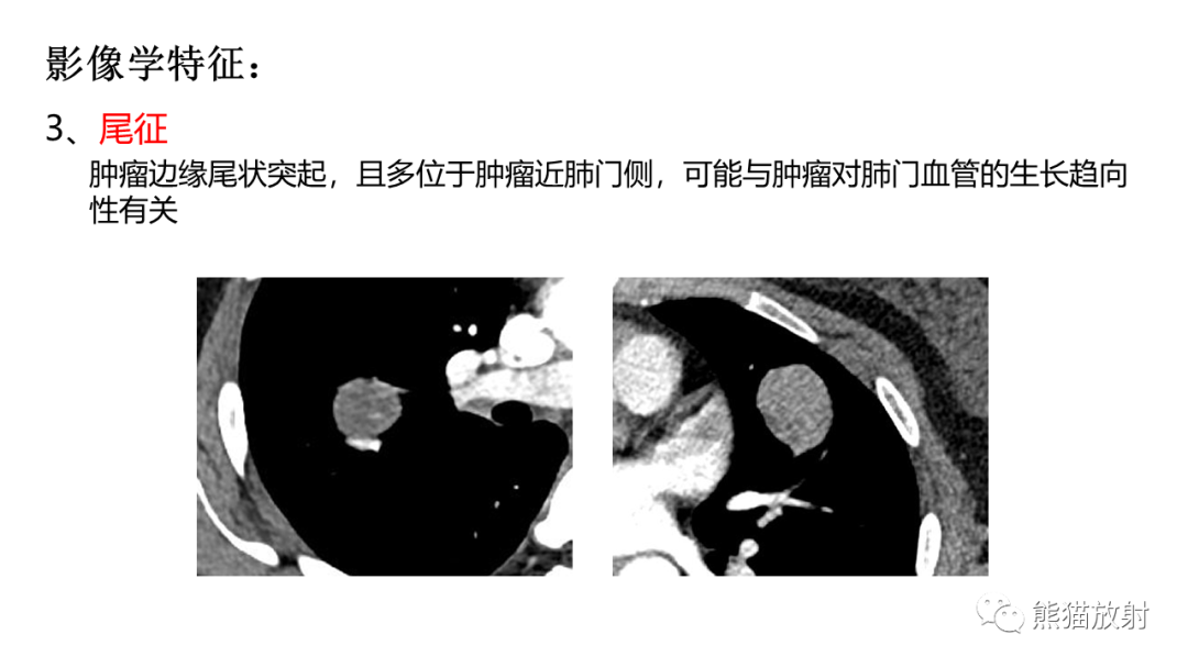 影像PPT - 【病例】肺孤立性纤维瘤 VS 硬化性肺细胞瘤-30