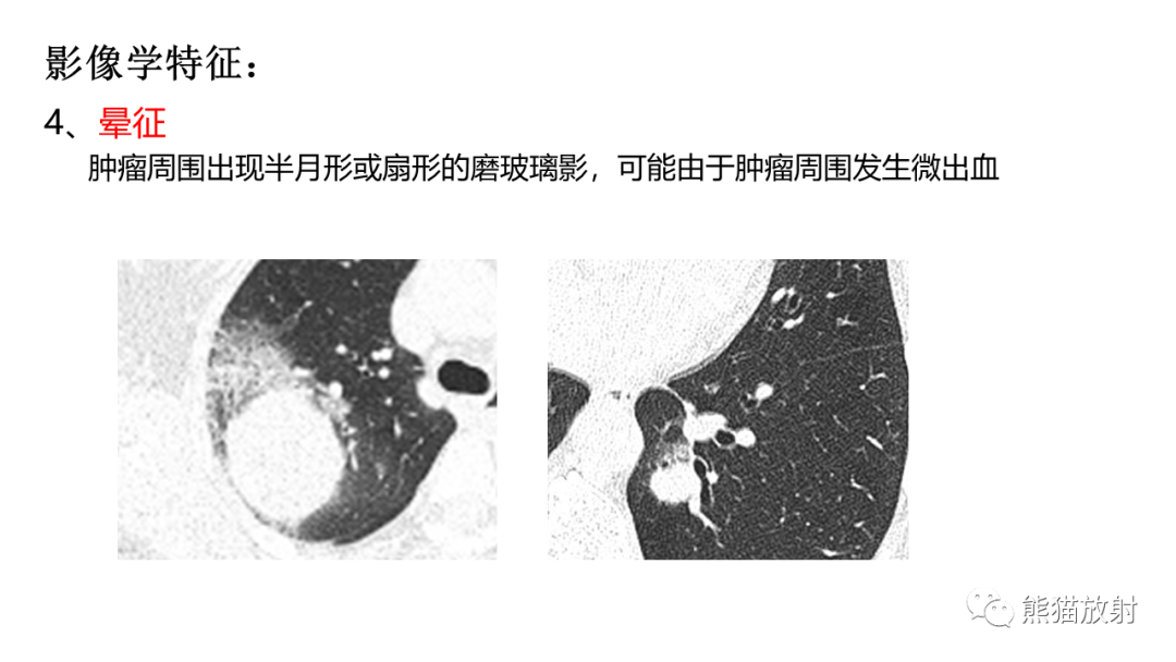 影像PPT - 【病例】肺孤立性纤维瘤 VS 硬化性肺细胞瘤-31