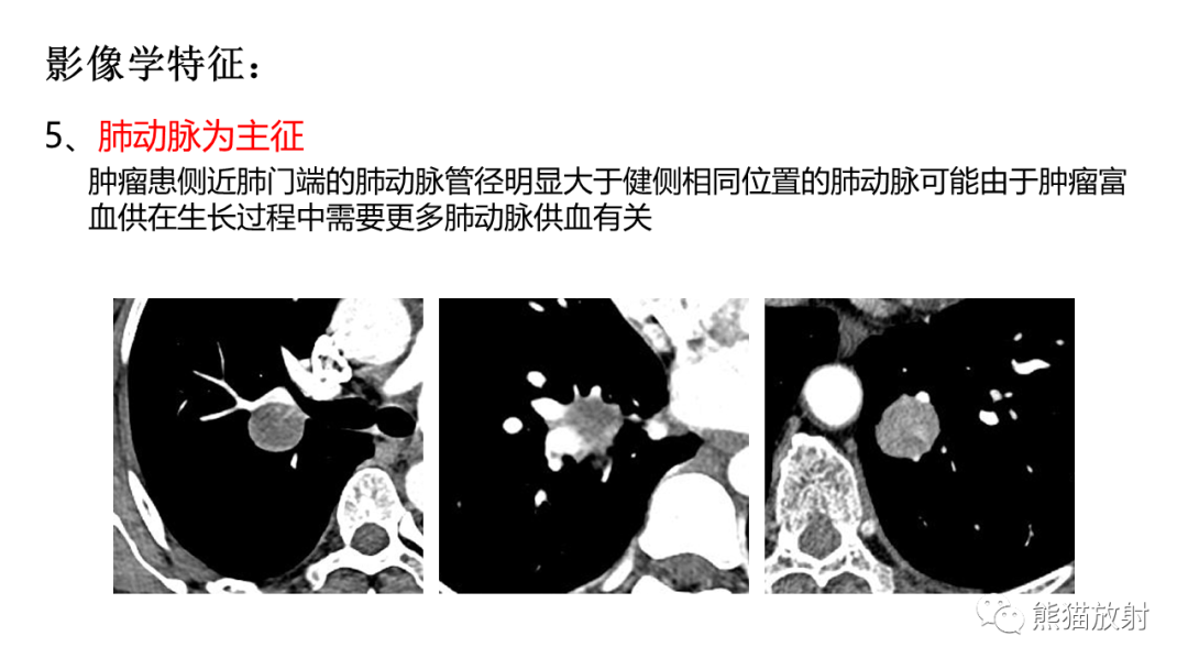 影像PPT - 【病例】肺孤立性纤维瘤 VS 硬化性肺细胞瘤-32