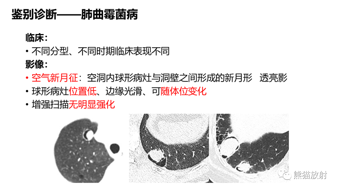 影像PPT - 【病例】肺孤立性纤维瘤 VS 硬化性肺细胞瘤-44