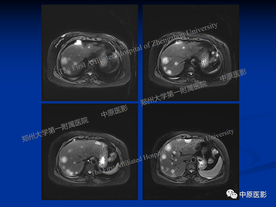 影像PPT - 【病例】肝脏上皮样血管内皮瘤1例MR影像-5