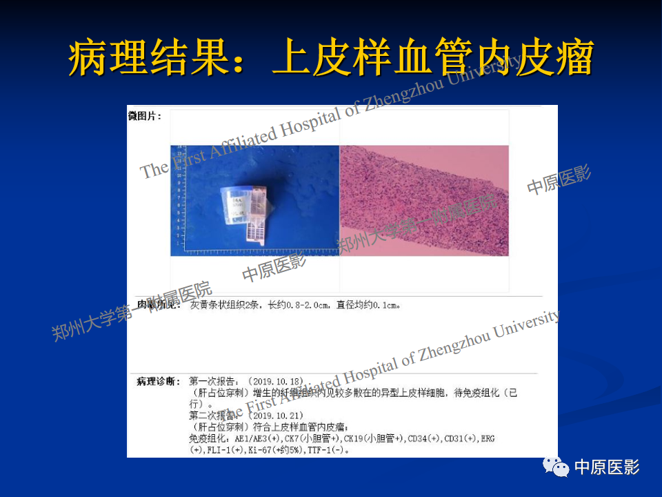 影像PPT - 【病例】肝脏上皮样血管内皮瘤1例MR影像-11