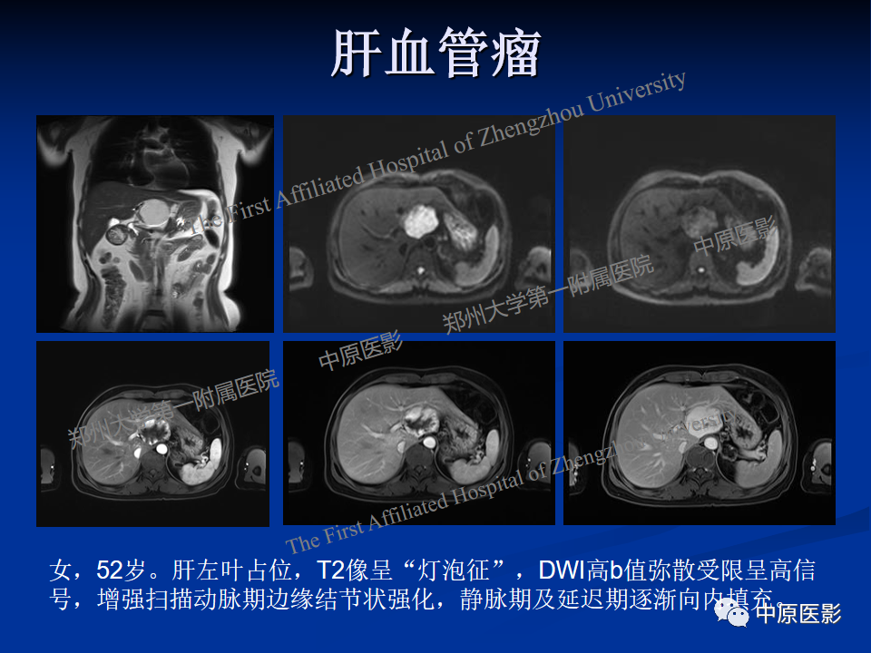 影像PPT - 【病例】肝脏上皮样血管内皮瘤1例MR影像-19