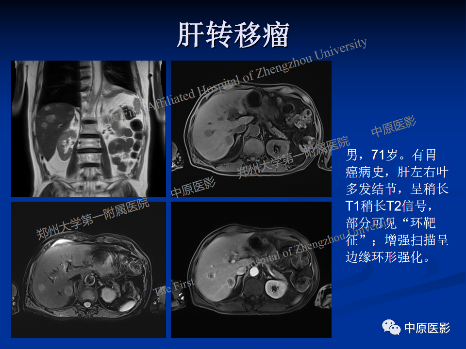 影像PPT - 【病例】肝脏上皮样血管内皮瘤1例MR影像-20