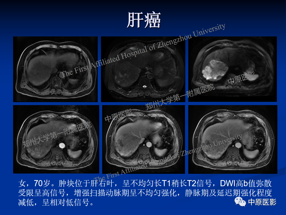 影像PPT - 【病例】肝脏上皮样血管内皮瘤1例MR影像-21