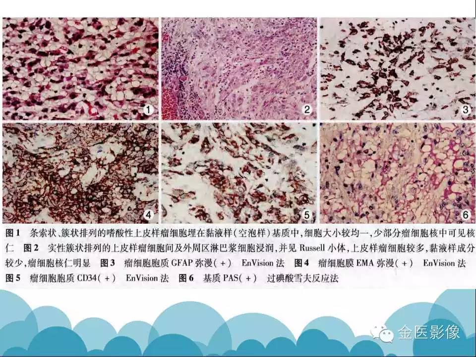 影像PPT - 【PPT】脊索样胶质瘤的影像表现-10