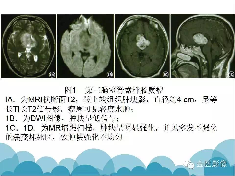 影像PPT - 【PPT】脊索样胶质瘤的影像表现-16