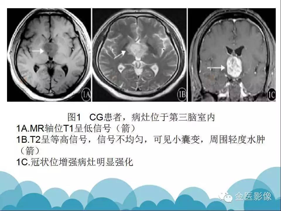 影像PPT - 【PPT】脊索样胶质瘤的影像表现-17