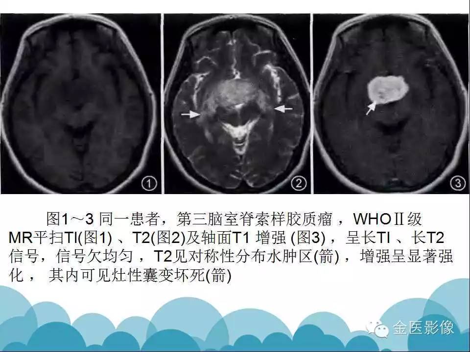 影像PPT - 【PPT】脊索样胶质瘤的影像表现-18