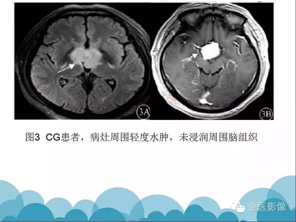 影像PPT - 【PPT】脊索样胶质瘤的影像表现-20