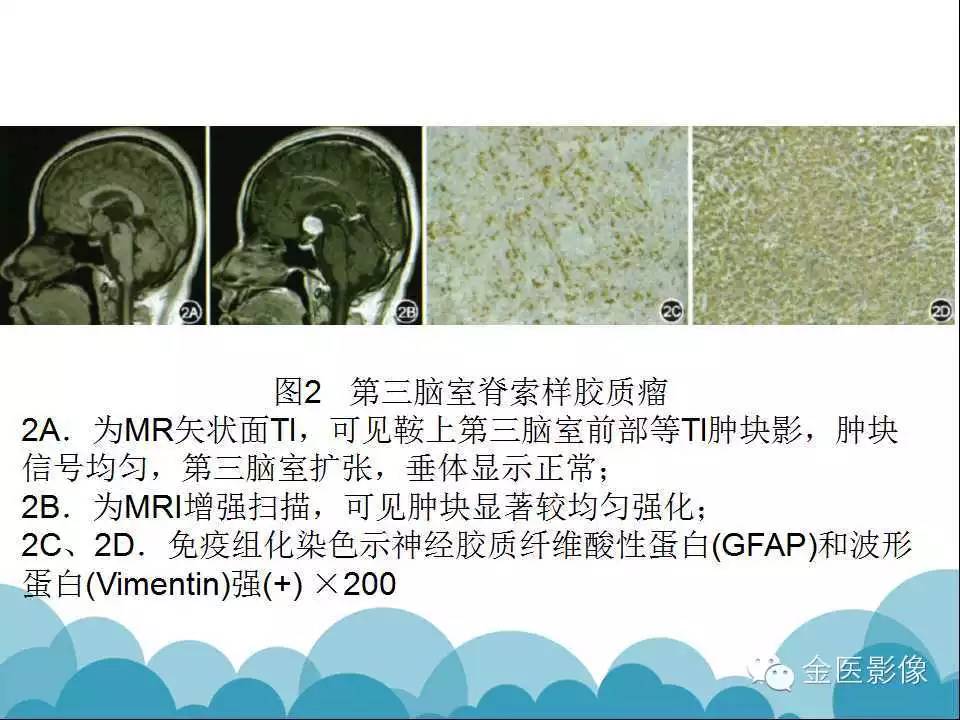 影像PPT - 【PPT】脊索样胶质瘤的影像表现-21