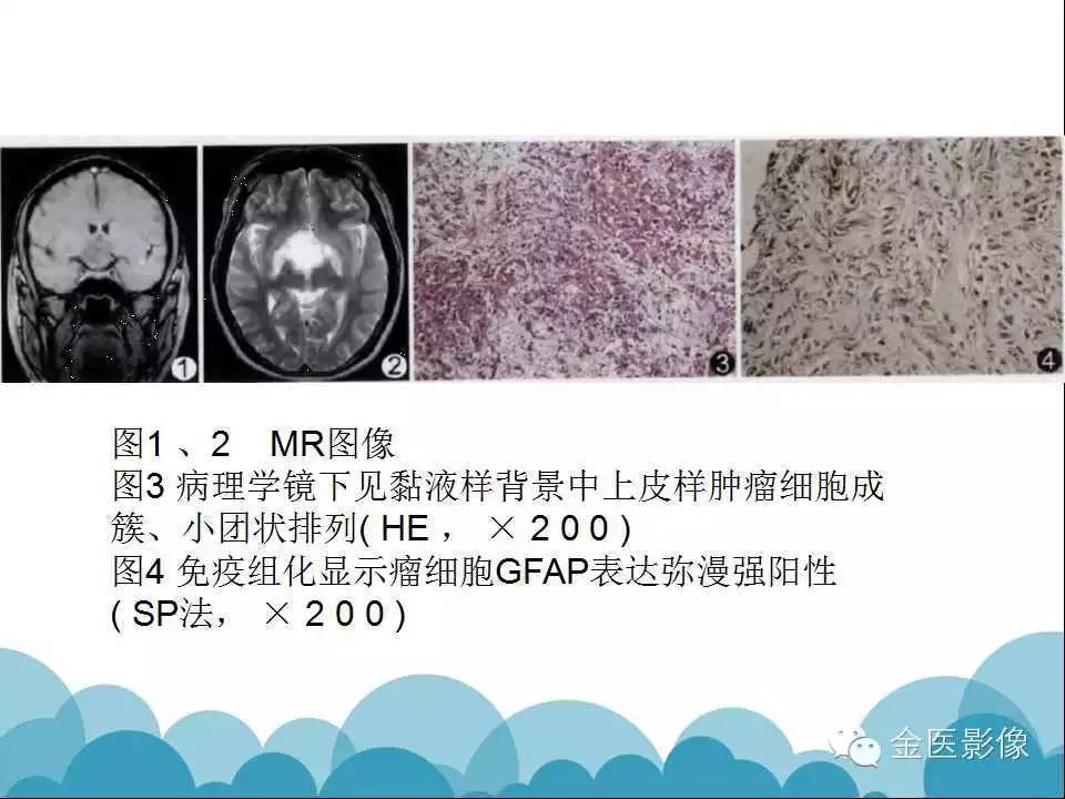 影像PPT - 【PPT】脊索样胶质瘤的影像表现-22