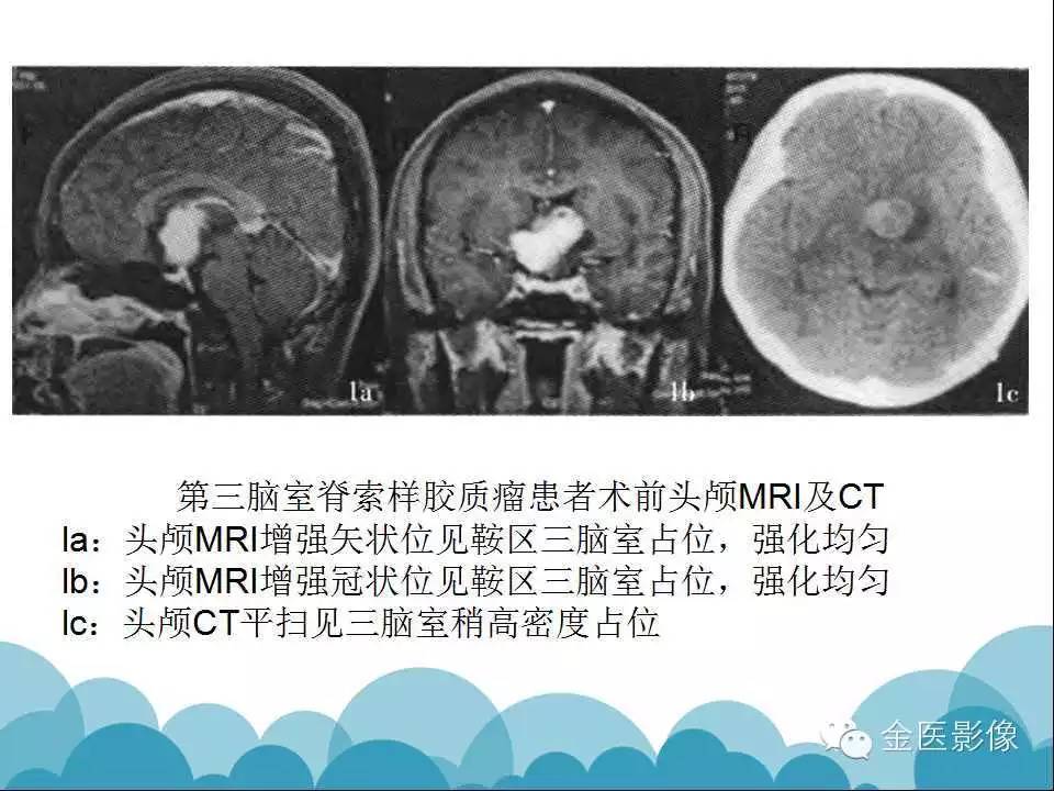 影像PPT - 【PPT】脊索样胶质瘤的影像表现-24