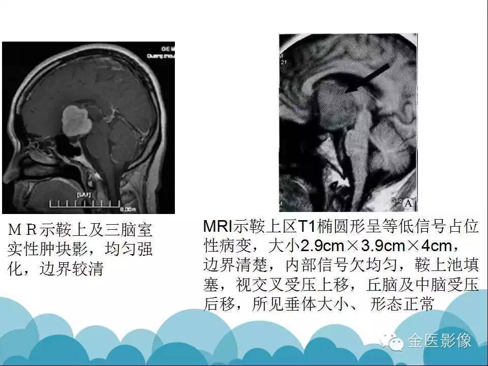 影像PPT - 【PPT】脊索样胶质瘤的影像表现-25