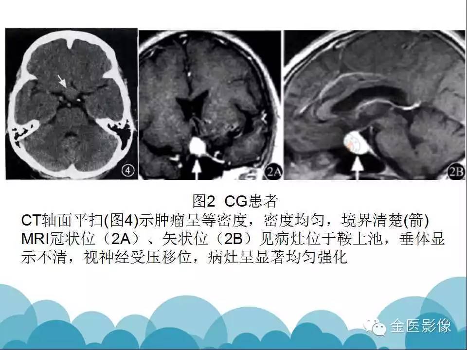 影像PPT - 【PPT】脊索样胶质瘤的影像表现-19