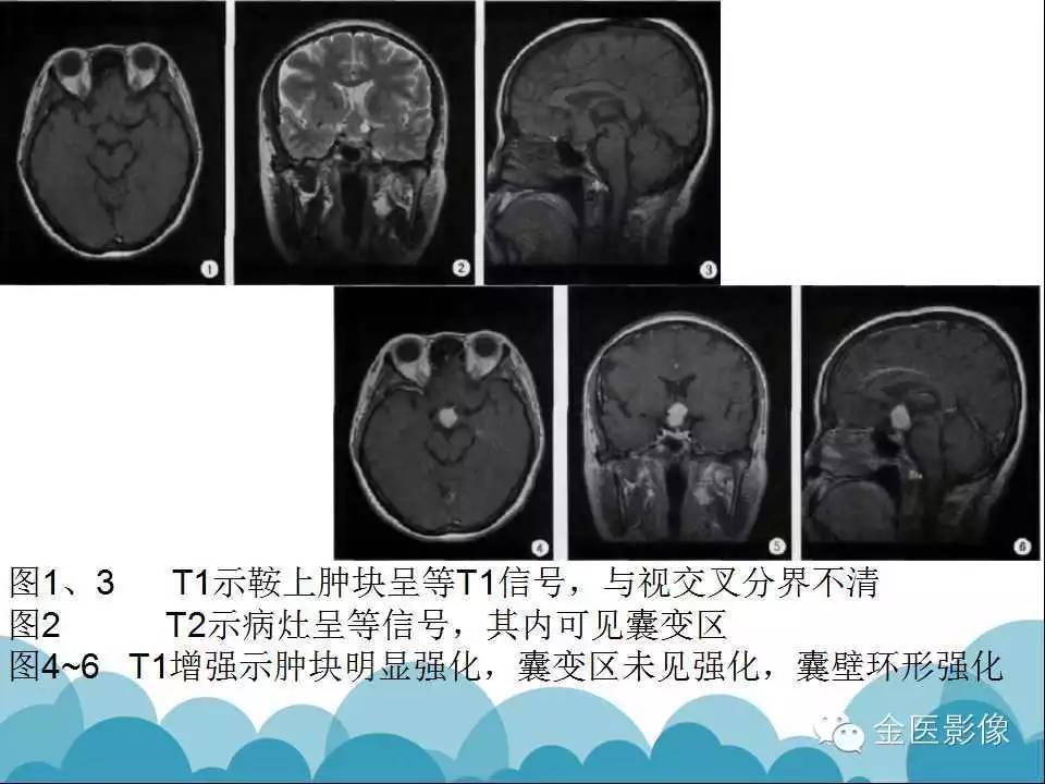 影像PPT - 【PPT】脊索样胶质瘤的影像表现-23