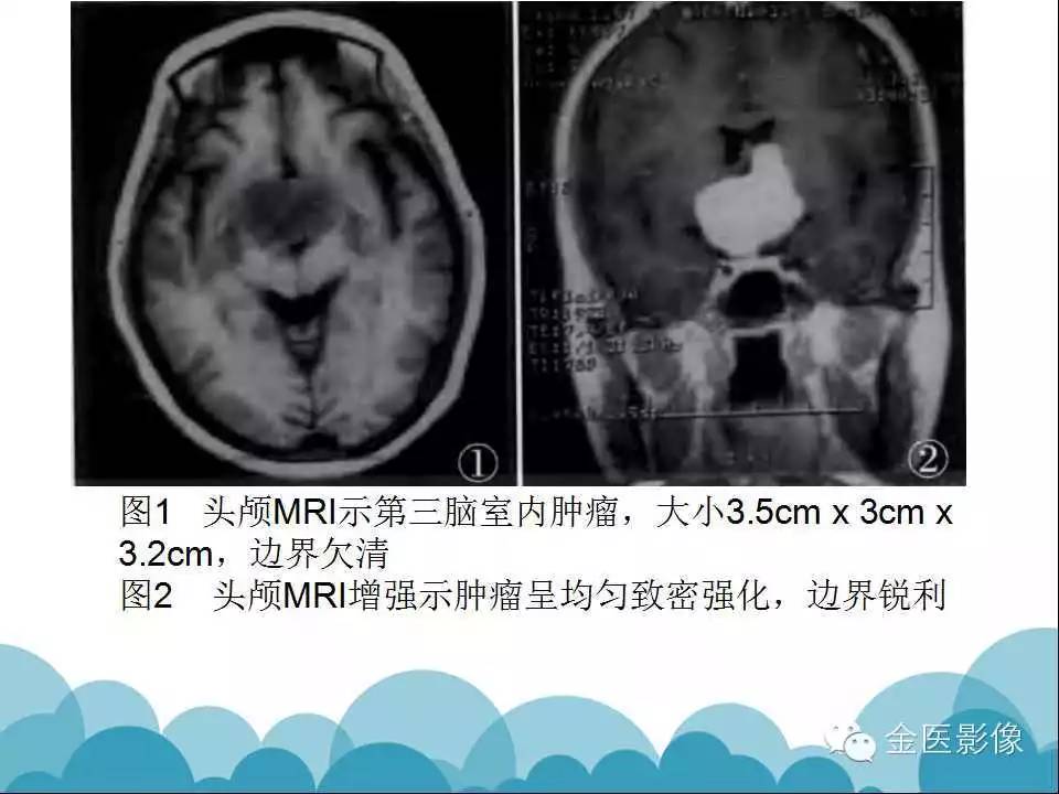 影像PPT - 【PPT】脊索样胶质瘤的影像表现-26