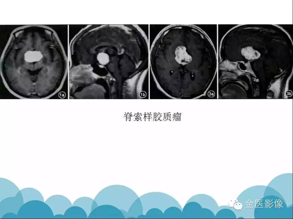 影像PPT - 【PPT】脊索样胶质瘤的影像表现-27