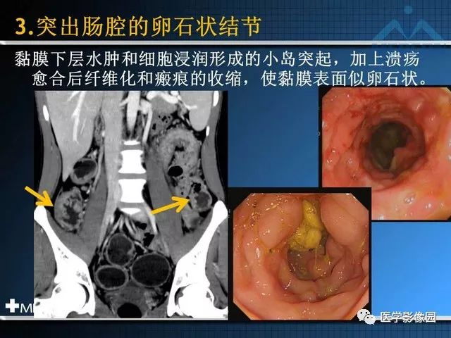 影像PPT - “梳样征”的影像诊断意义-15
