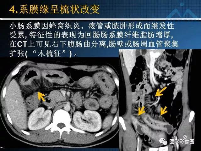影像PPT - “梳样征”的影像诊断意义-17
