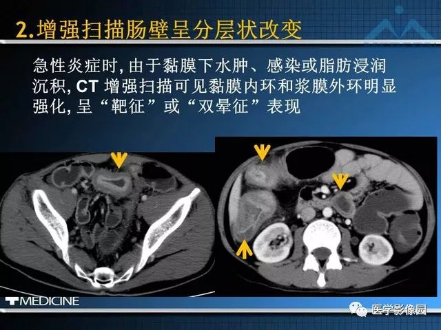 影像PPT - “梳样征”的影像诊断意义-13