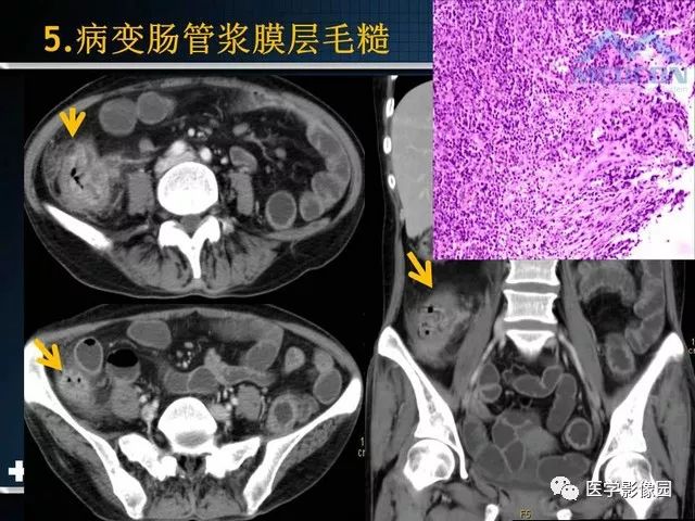 影像PPT - “梳样征”的影像诊断意义-18