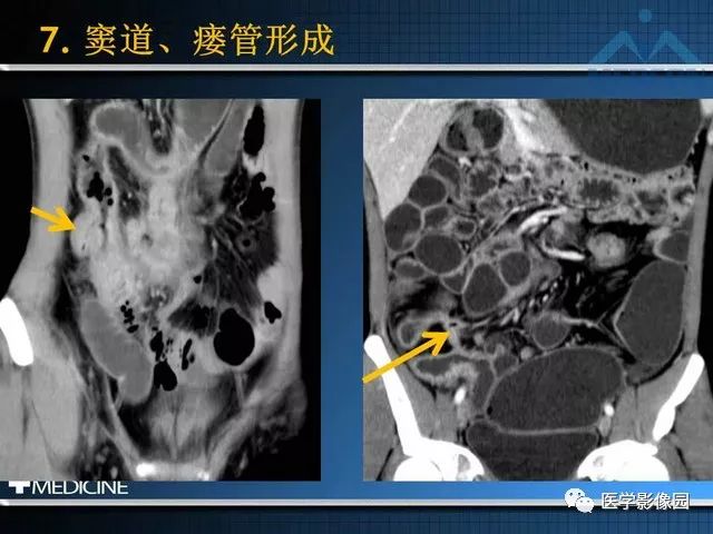 影像PPT - “梳样征”的影像诊断意义-20