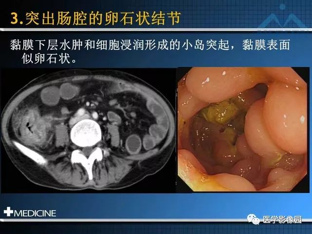影像PPT - “梳样征”的影像诊断意义-16