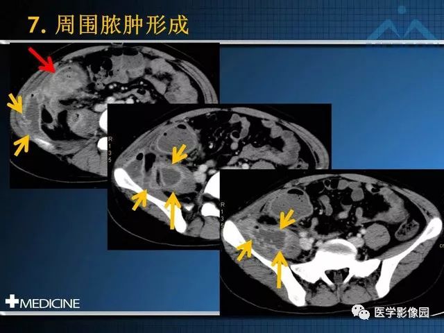 影像PPT - “梳样征”的影像诊断意义-21