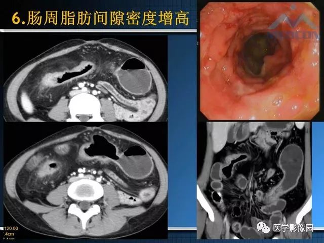 影像PPT - “梳样征”的影像诊断意义-19