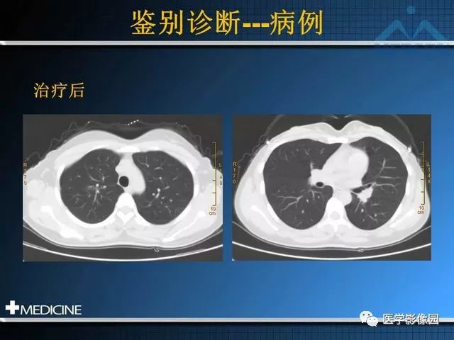 影像PPT - “梳样征”的影像诊断意义-29