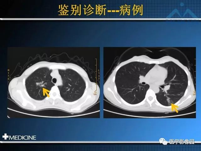 影像PPT - “梳样征”的影像诊断意义-28