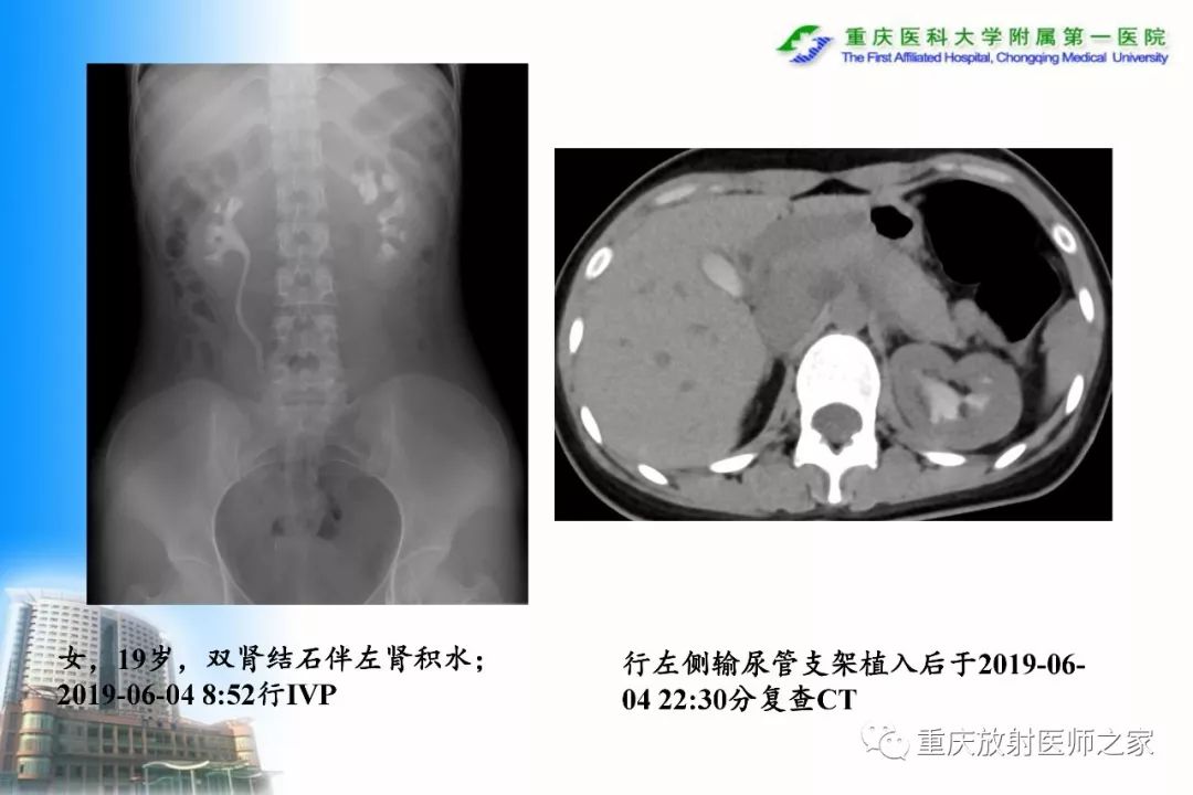 影像PPT - 【PPT】碘对比剂CT增强的影响因素与临床应用-6