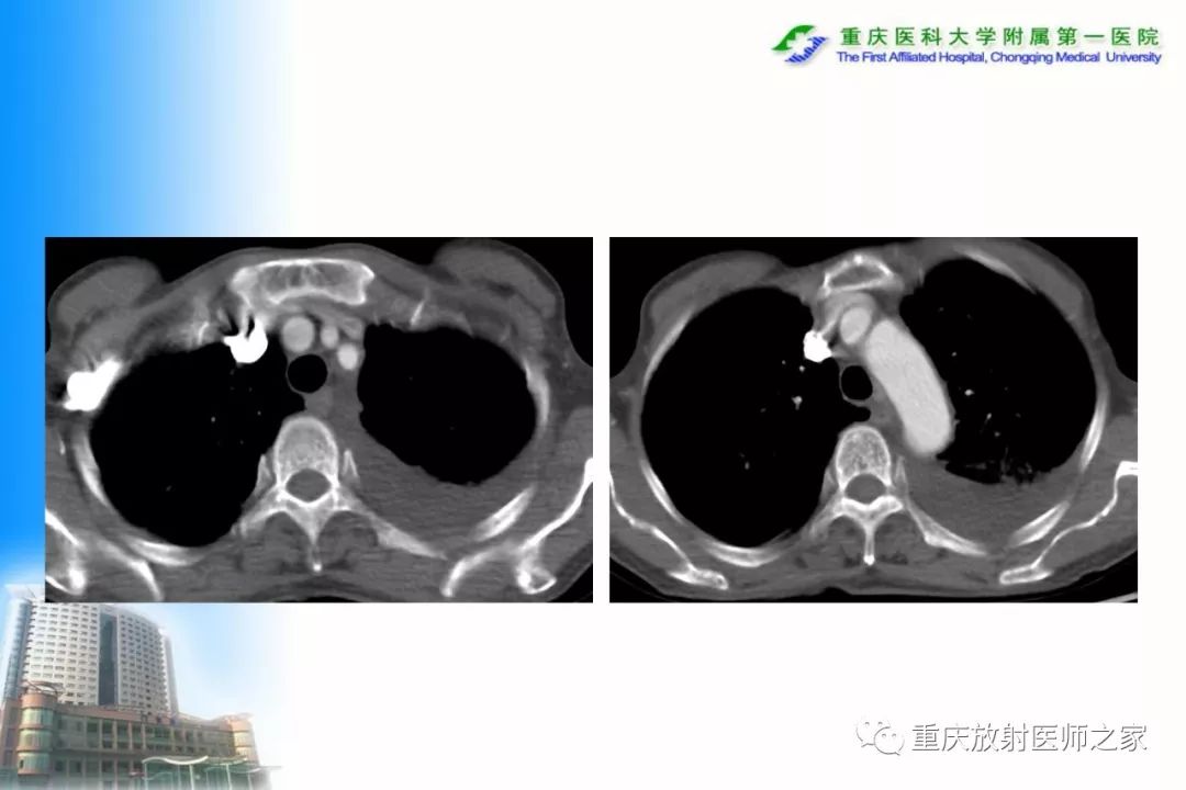 影像PPT - 【PPT】碘对比剂CT增强的影响因素与临床应用-22