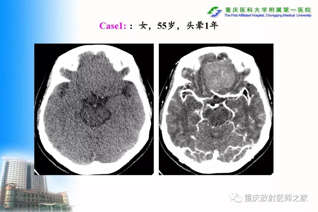 影像PPT - 【PPT】碘对比剂CT增强的影响因素与临床应用-37