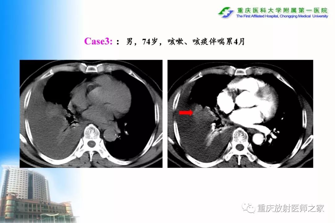 影像PPT - 【PPT】碘对比剂CT增强的影响因素与临床应用-39