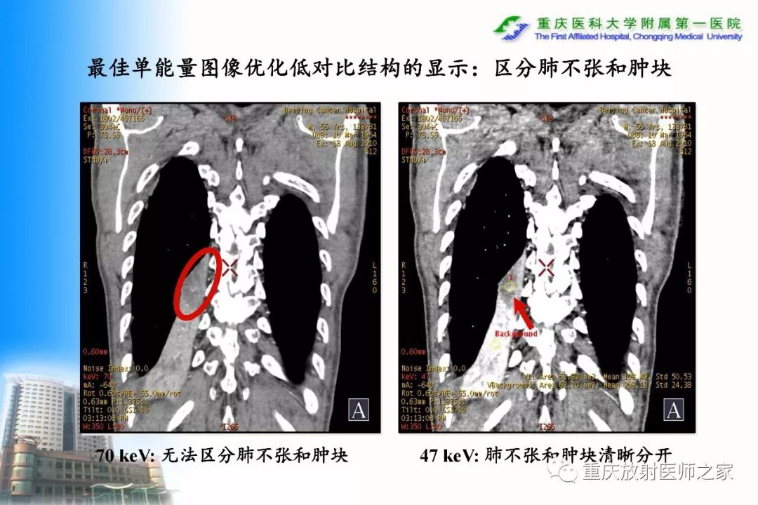 影像PPT - 【PPT】碘对比剂CT增强的影响因素与临床应用-42