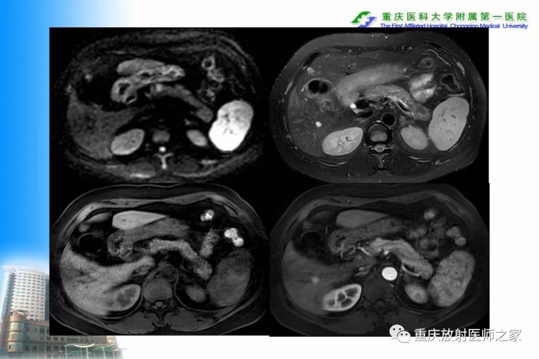 影像PPT - 【PPT】碘对比剂CT增强的影响因素与临床应用-45