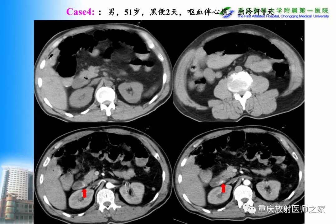 影像PPT - 【PPT】碘对比剂CT增强的影响因素与临床应用-46