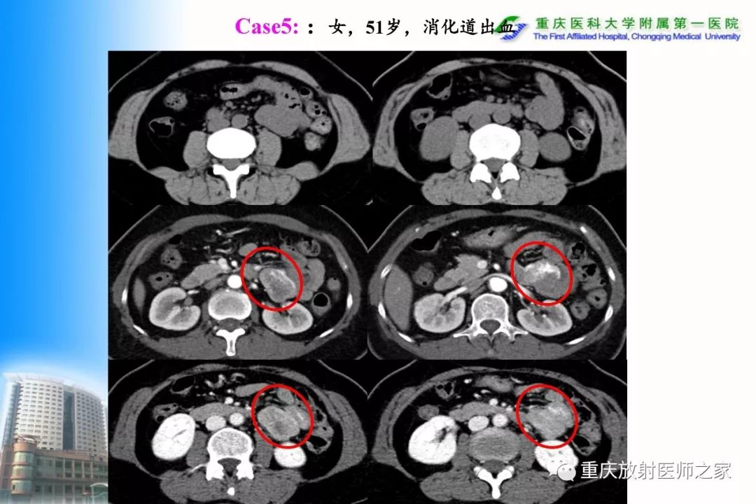 影像PPT - 【PPT】碘对比剂CT增强的影响因素与临床应用-47