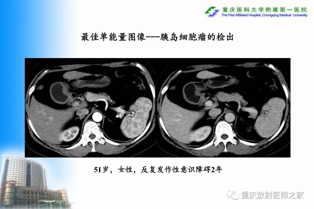 影像PPT - 【PPT】碘对比剂CT增强的影响因素与临床应用-43